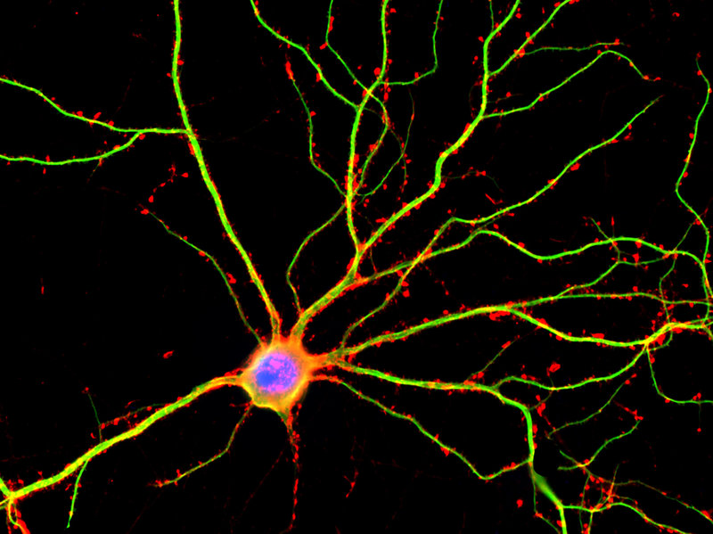 Radiculopathy